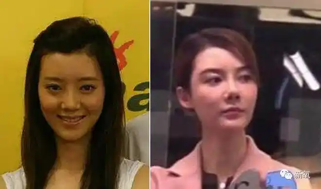 鼻小柱|车晓|假体_网易订阅