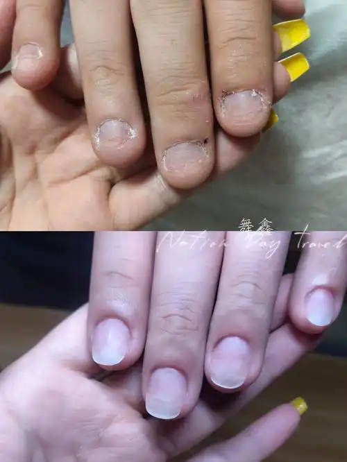 啃咬甲修复矫正