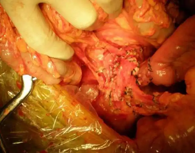 脖子淋巴瘤早期图片_有来医生