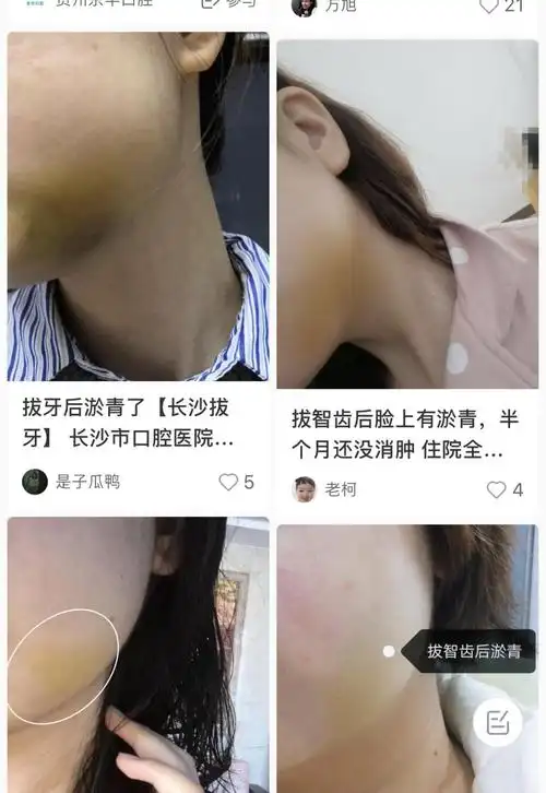 拔智齿后脸发青发黄怎么回事?