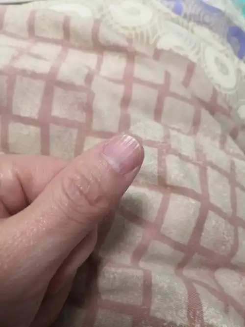 指甲竖纹
