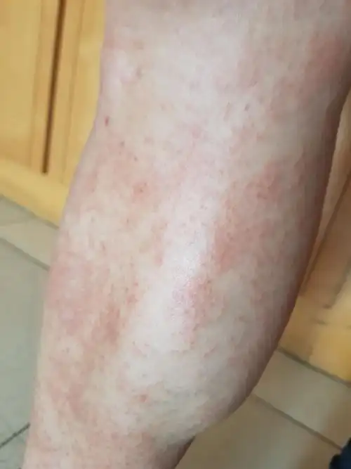 我爸的皮肤过敏,身上都有,又红又痒,都半个多月,请问怎么办啊,求人