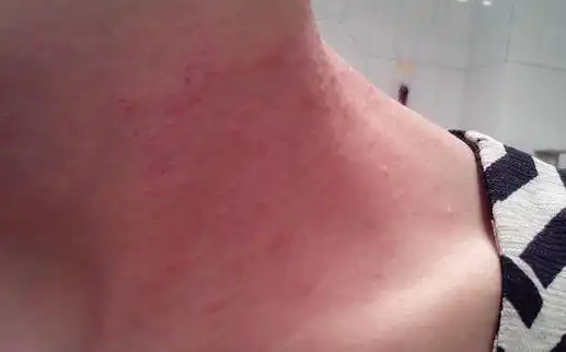 皮肤过敏早期症状图片