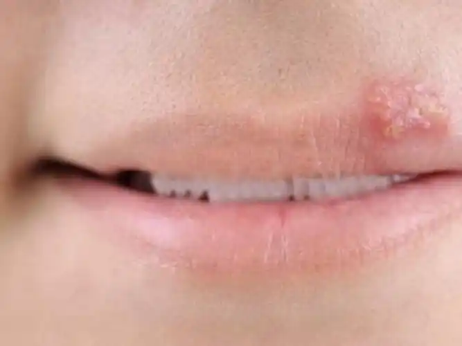 单纯疱疹是由单纯疱疹病毒引起,有自限性但容易复发.