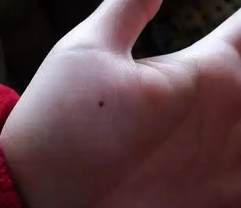 手臂上超过12颗痣,小心黑色素瘤!数一数你手臂上有多少痣