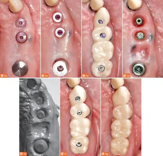 最终正式戴入种植体支持式螺丝固位固定桥,用聚四氟乙烯胶带(也称为特