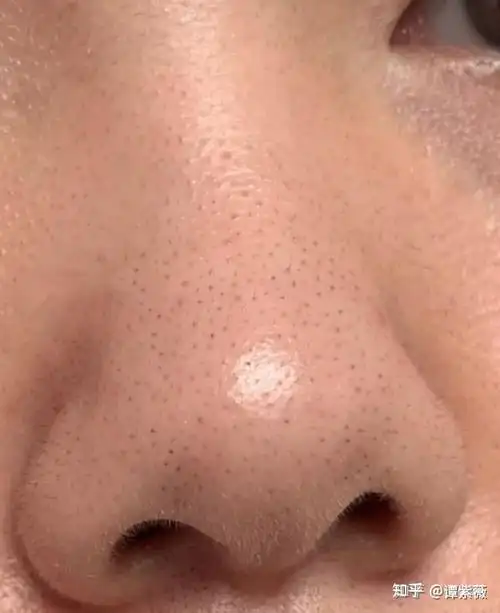 第二种,中度黑头,毛孔粗大,黑头明显