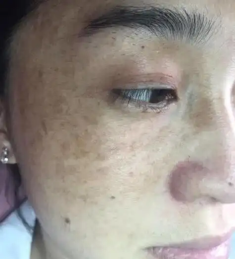 肤色暗沉发黑是什么原因