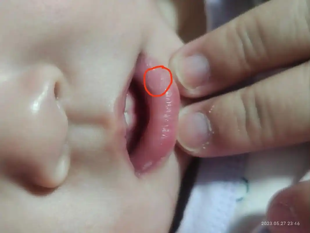 前两天发现宝宝嘴角有点白白的东西,以 - 抖音