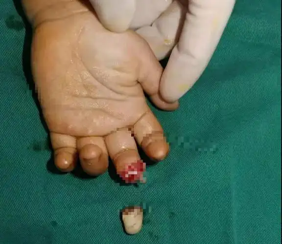 "兔子急了也咬人"真实版在河南上演!1岁大孩子被咬掉手指,家长们警惕