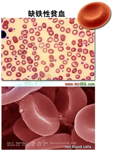 缺铁性贫血红细胞形态什么样