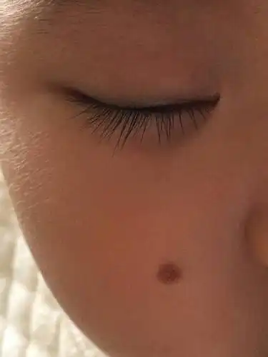 宝宝脸上的痣
