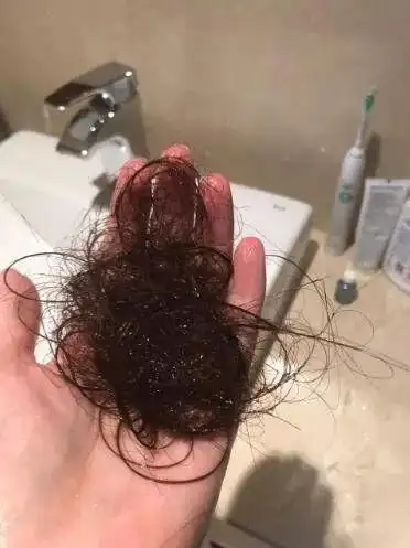 别看最早的一批90后也才30岁,80后90后已经占据脱发人群的74.6%