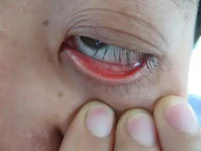 慢性结膜炎的症状图片,慢性结膜炎图片大全_慢性结膜炎_39疾病百科