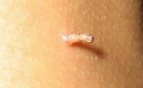 疣要预防感染丝状疣主要由人类乳头瘤病毒所引起,通过直接接触传染,如