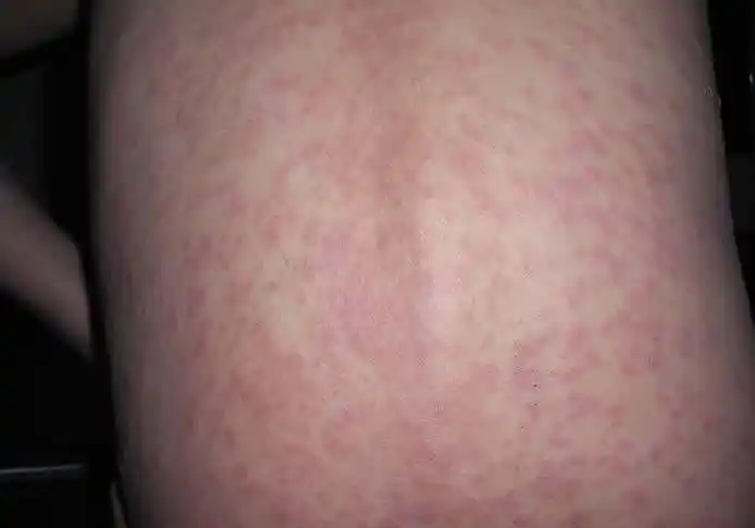 婴儿湿疹和热疹的区别图片(高清对比)