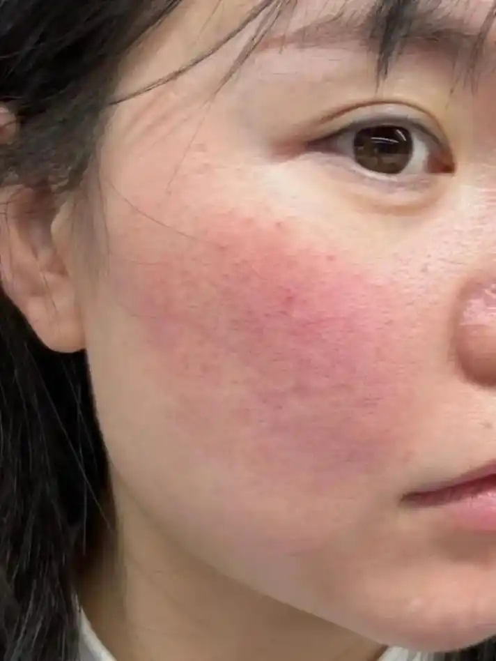 这修护效果也太顶了叭!红脸蛋就这样 - 抖音