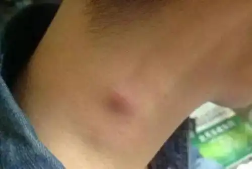 5淋巴结肿还有一种比较严重的脖子上长肉疙瘩的现象就是,你已经患上了