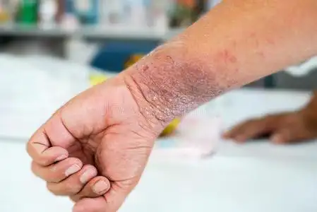 渗出性湿疹图片