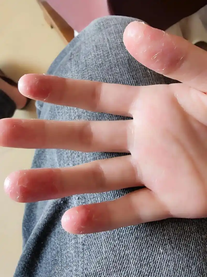 求助.各位大神 小孩子的指甲不长  皮肤烂成这样有什么好的办 - 抖音