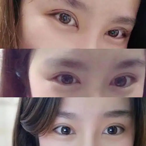 发射一波全切双眼皮,开眼角,去皮去脂经历!