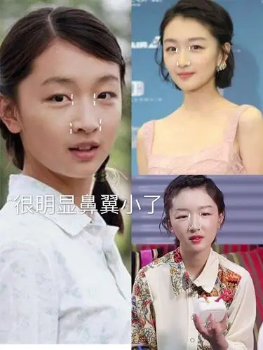 文艺片女神的"小黄鸭"周冬雨脸肿的衰老十岁,原来也整容了
