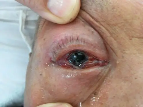 【眼表疾病讨论】球结膜高度水肿的原因 [病例帖]