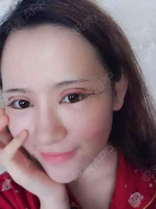 全切双眼皮术后3天_眼综合术后3天_双眼皮术后3天_眼部整形术后3天