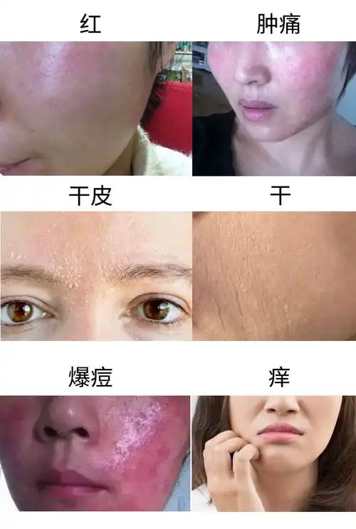 皮肤屏障受损症状图片和原因怎样快速修复皮肤屏障揭秘
