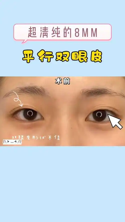 超清纯的8mm平行的双眼皮!_双眼皮_mm