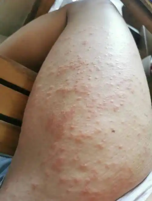 一周拯救皮肤干痒红疹,康复者消疹秘诀大公开,原来湿疹去根竟如此简单