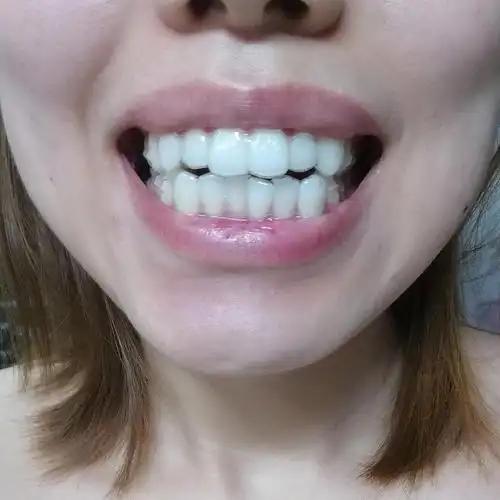 隐形第一天,牙齿闭合不上