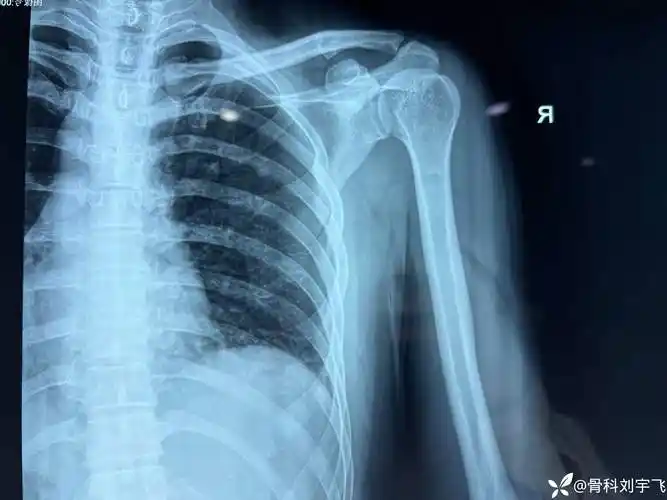 视频教学:简单实用"外展外旋法"复位肩关节前脱位