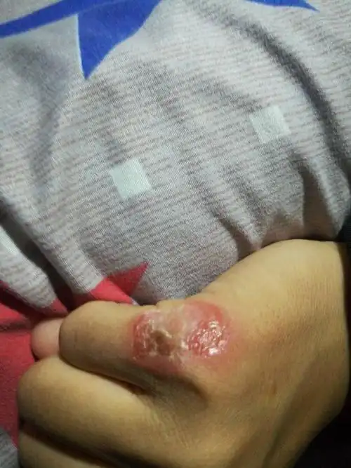 这么大的伤口回留疤吗,因为发炎才变成这样的