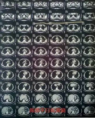 胸部ct平扫(纵隔窗)