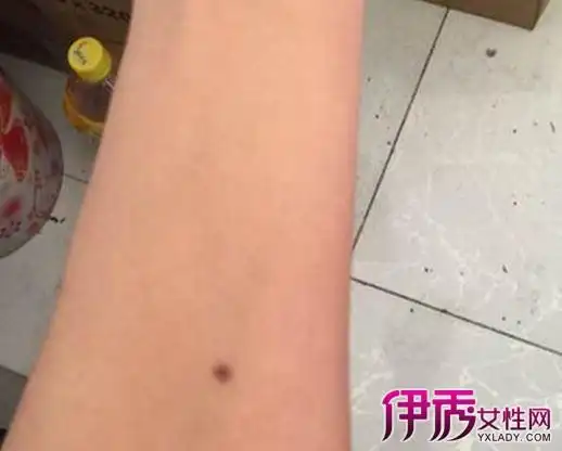 【图】手臂上有痣代表什么意思 8种痣相大讲解