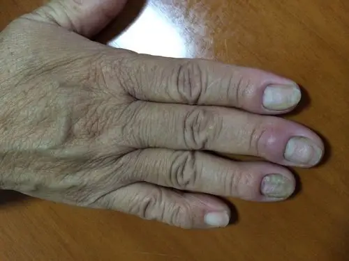 母亲手指指甲根部红肿(如图),按压时会痛,请问是什么情况,如何治疗?