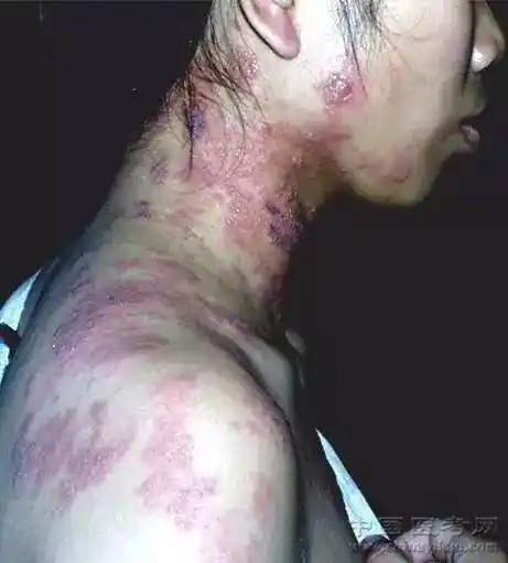 史上最全常见皮肤病图谱