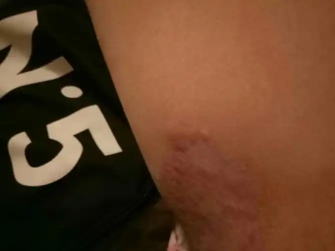 男,下体两侧晚上会奇痒无比,最近一直抓,颜色变深