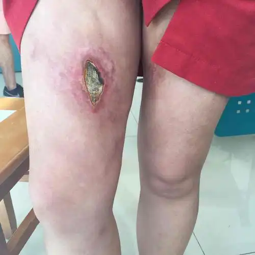 大腿抽脂术后感染一例