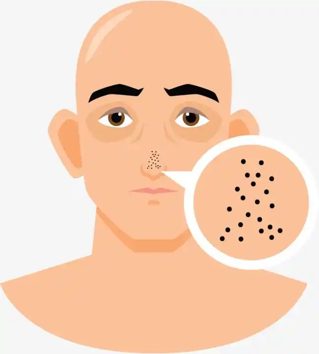 痤疮青春痘治疗之黑头的预防及医美疗法-健康160