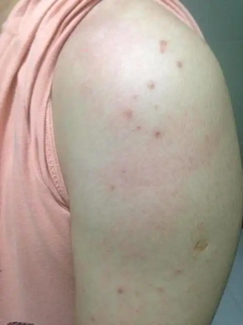 皮肤科专业学员!艾滋病专家!这个只有你们能看懂啊!