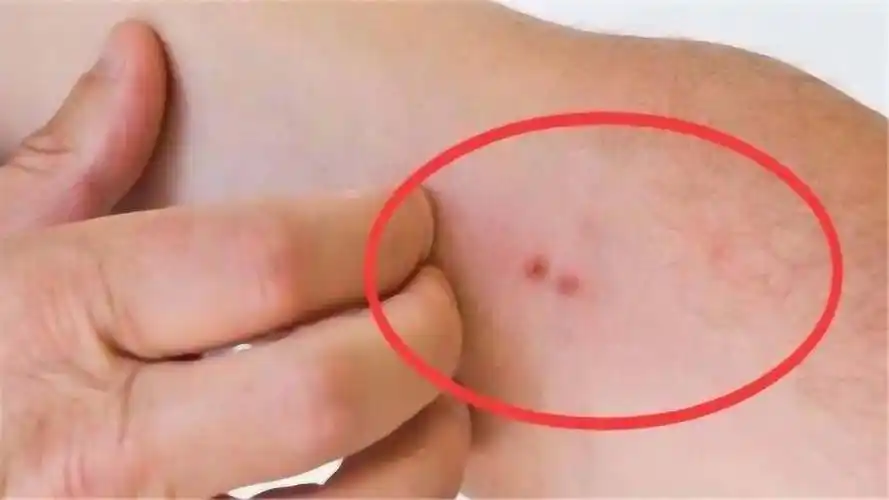 肝癌发生悄无声息,一旦皮肤有4种"标记",别怀疑,去医院!