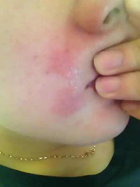 我的脸过敏一个月了,没有查出过敏原,刚开_有问必答_快速问医生