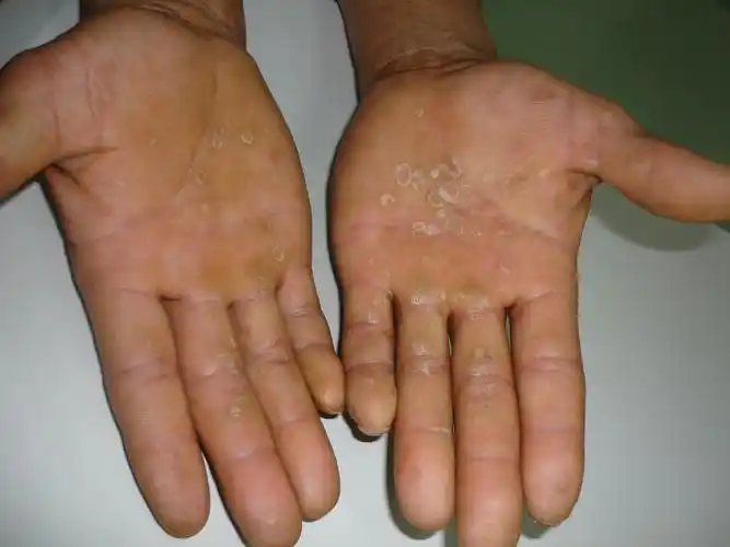 典型病例——二期梅毒