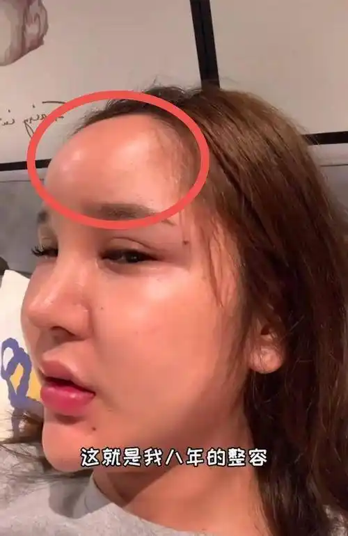 网红揭秘整容后遗症,假体下滑,玻尿酸被撑松,看上去很僵硬_影响_网络_