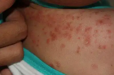 疥疮临床表现有哪些