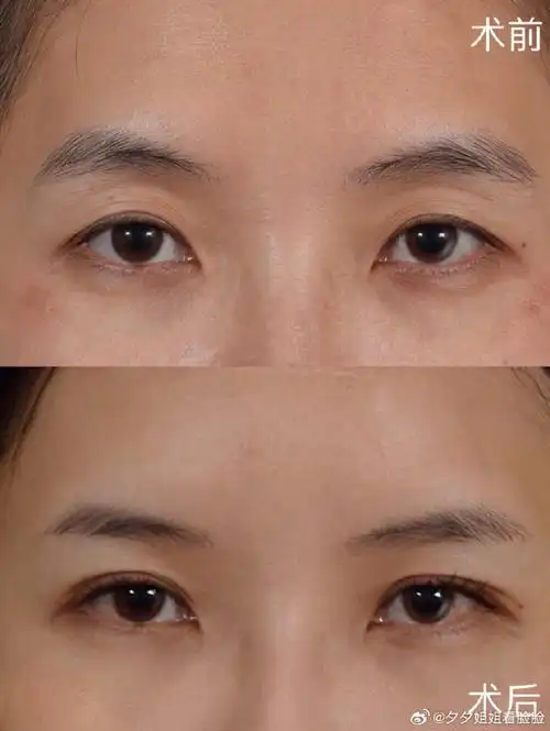 脂肪胶填充丰眼窝,分享