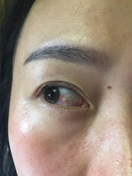 李医生你好第一张是一个月前的泡性结膜炎的照片第二张是上