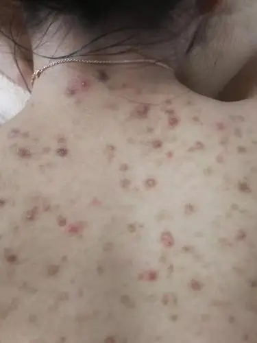 写美篇细菌性毛囊炎由细菌引起,起病急,病程较短.